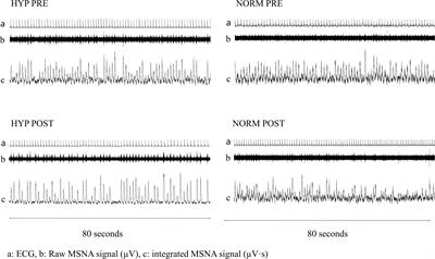 High-Intensity Interval Training Decreases Muscle Sympathetic Nerve Activity in Men With Essential Hypertension and in Normotensive Controls